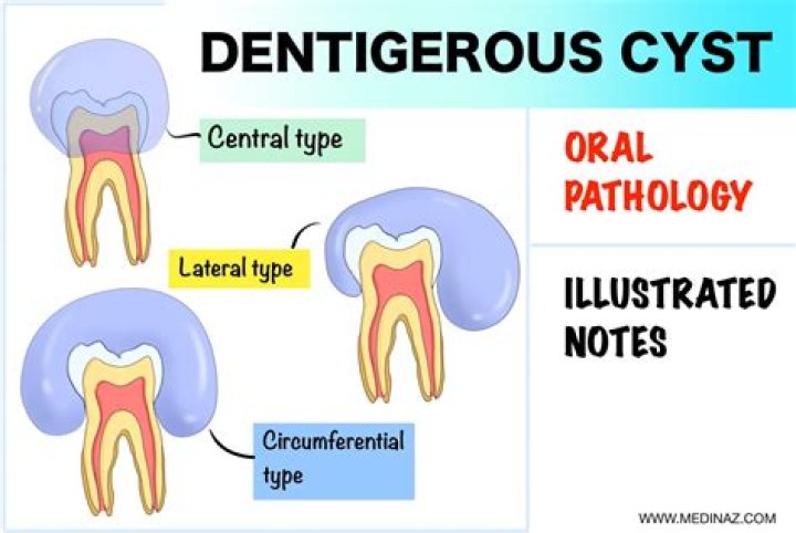 What is a dentigerous cyst?