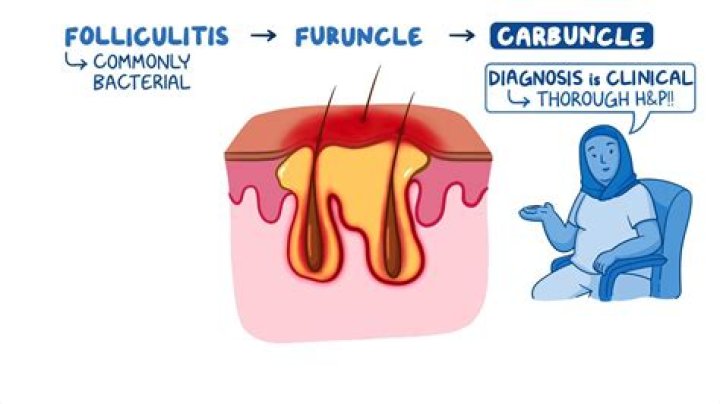 What is a furuncle cyst?