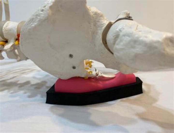 What is a sacro wedgy?