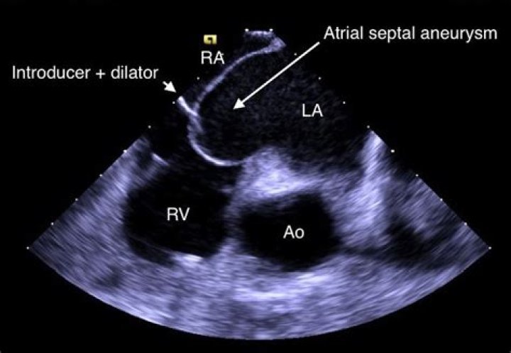 What is aneurysmal interatrial septum?