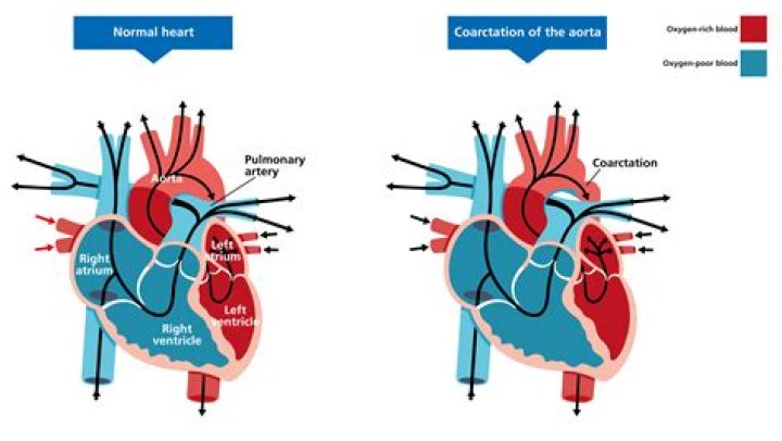 What is aorta disease?