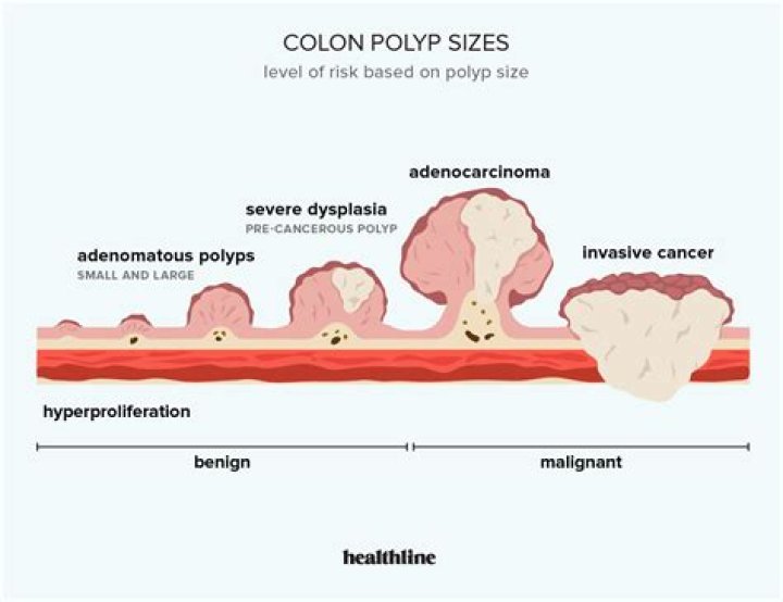 What is appendiceal orifice polyp?