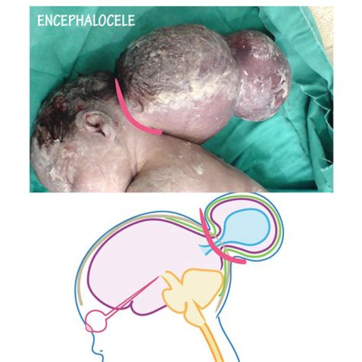 What is atretic encephalocele?