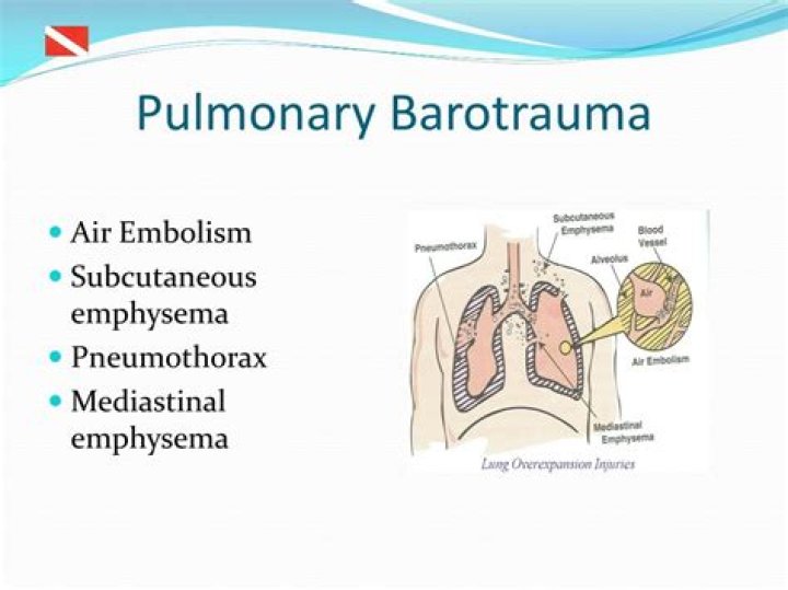 What is barotrauma lungs?