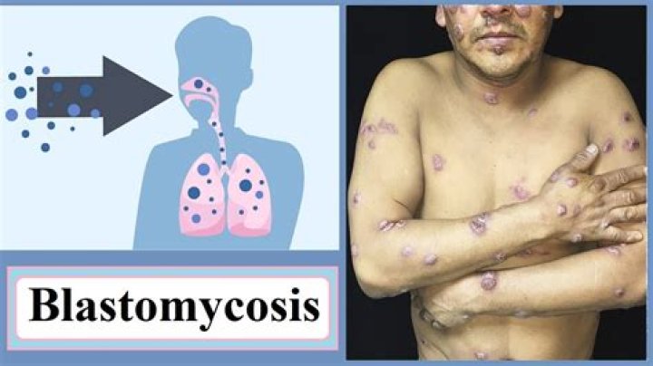 What is blastomycosis in humans?