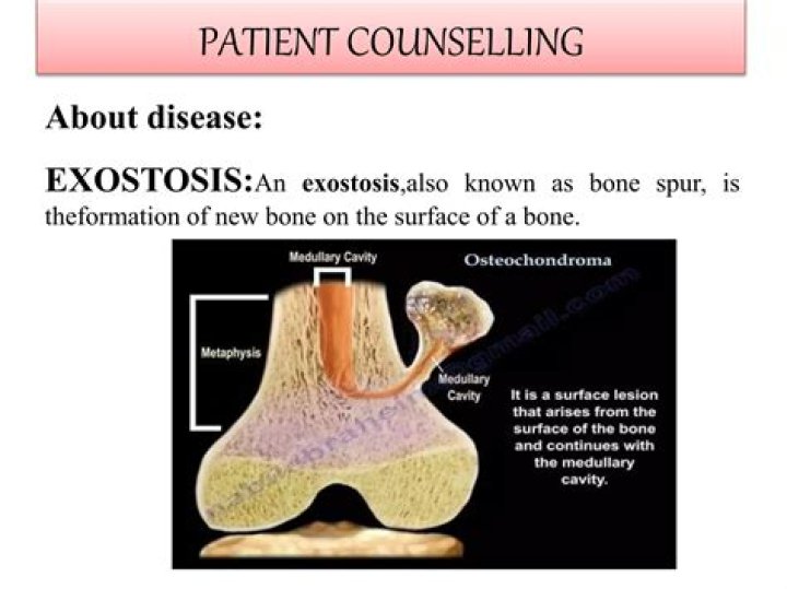 What is bony exostosis?