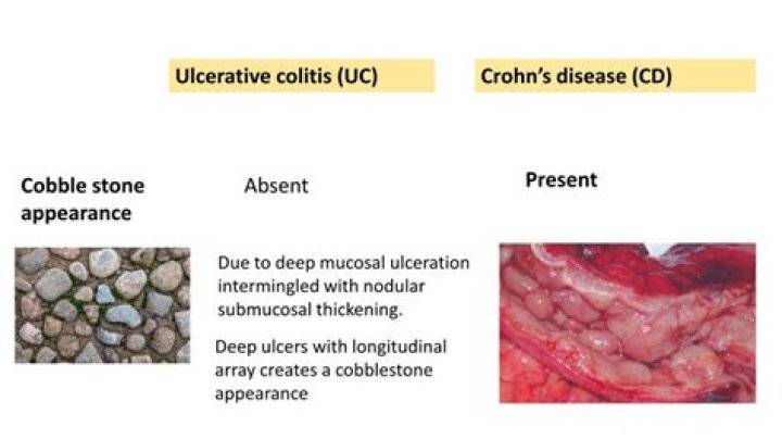 What is cobblestone mucosa?