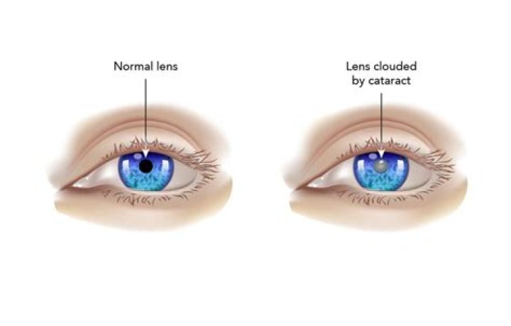 What is cupuliform cataract?