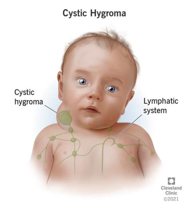 What is cystic hygroma?