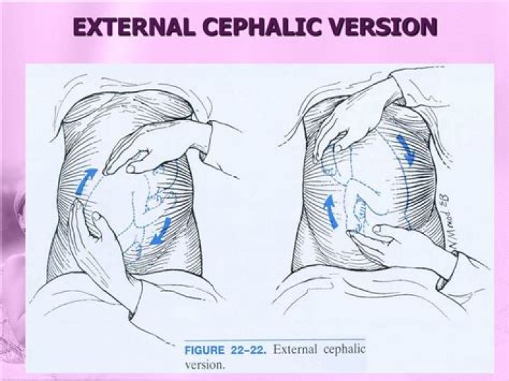 What is external cephalic version?