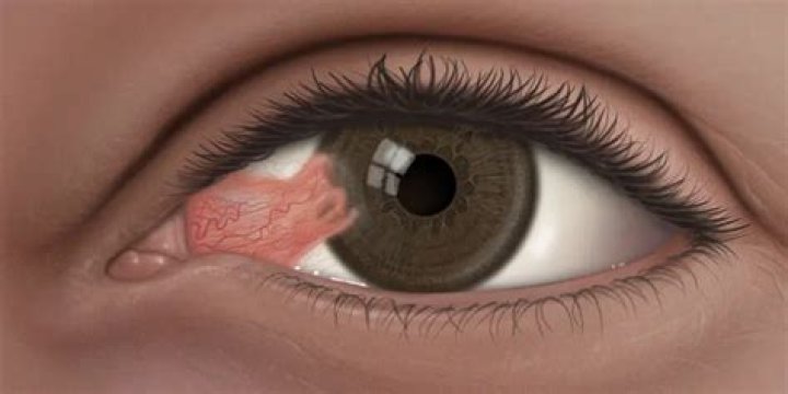 What is eye carnosity?