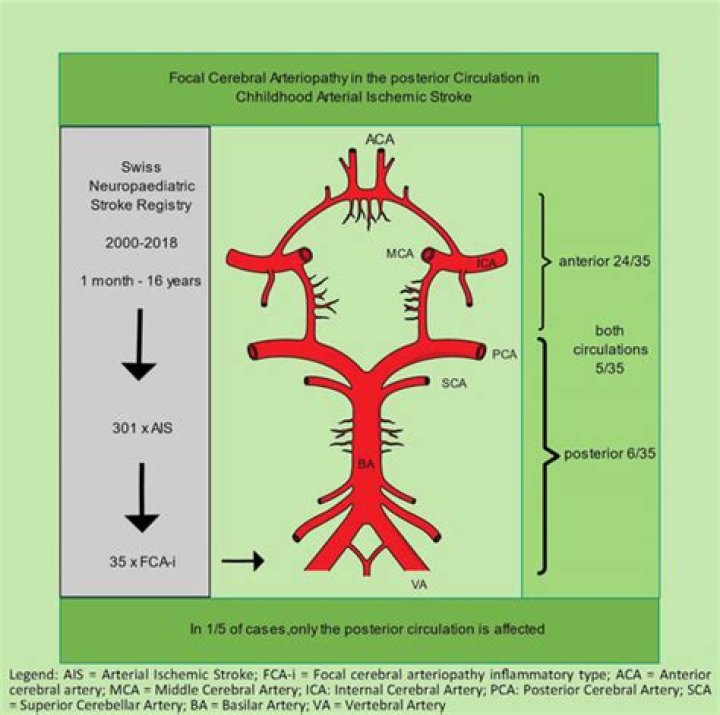 What is focal cerebral arteriopathy?