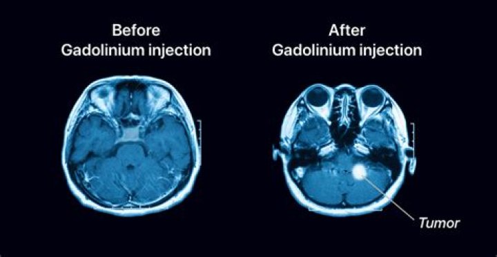 What is gadolinium mri?