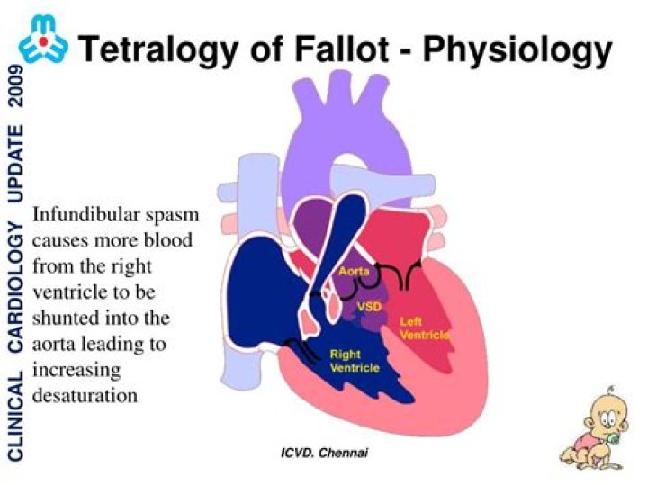 What is infundibular spasm?