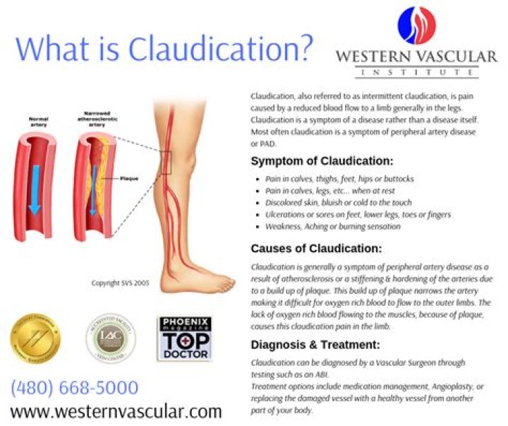 What is intermittent claudication?
