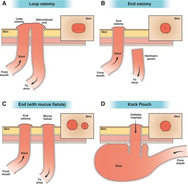What is meant by ileocolostomy?