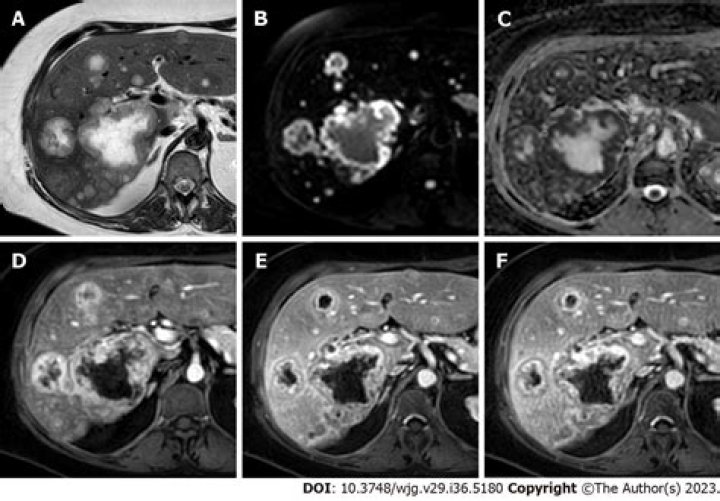 What is metastatic hypernephroma?