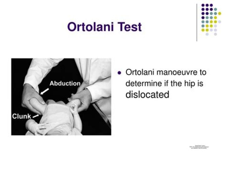 What is ortolani test?