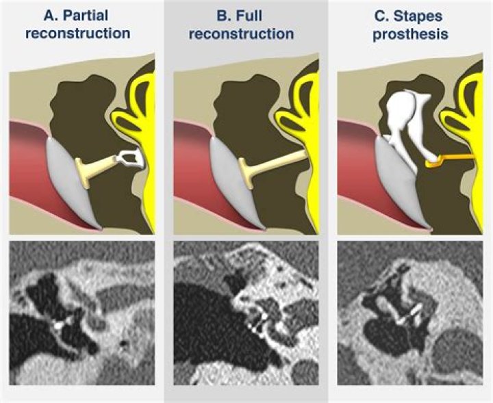 What is ossicular chain reconstruction?