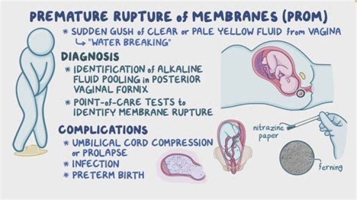 What is premature rupture of membranes?