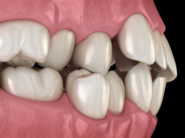What is protruding teeth?
