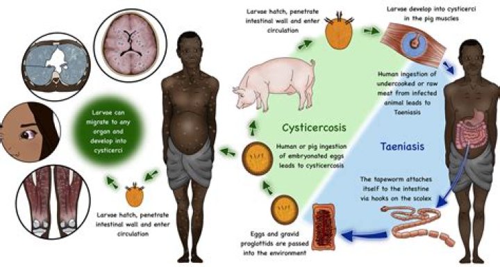 What is taenia infection?