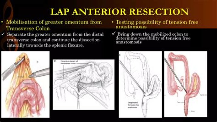 What is the definition of ultralow anterior resection?