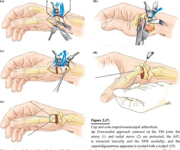 What is trapeziometacarpal arthritis?