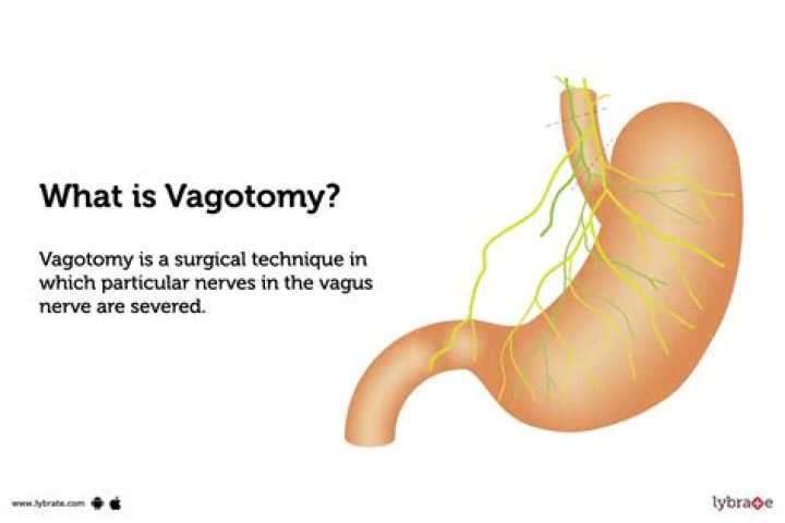 What is vagotomy surgery?