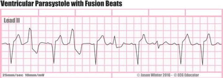 What is ventricular parasystole?