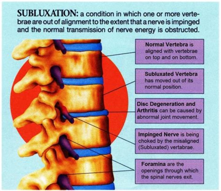 What is vertebral subluxation?