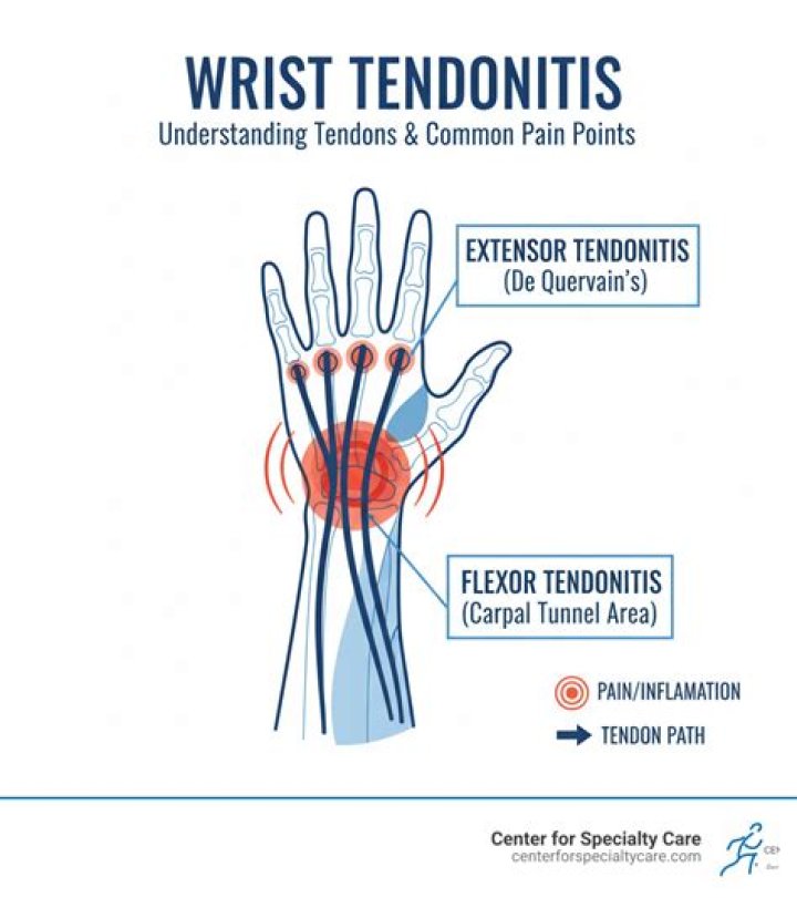 What is wrist hand orthosis?