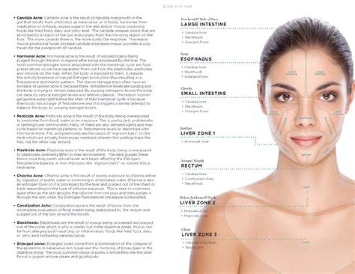 What really causes acne?