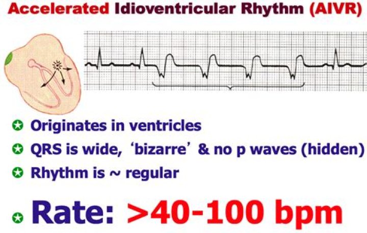 What rhythm originates from the ventricle?