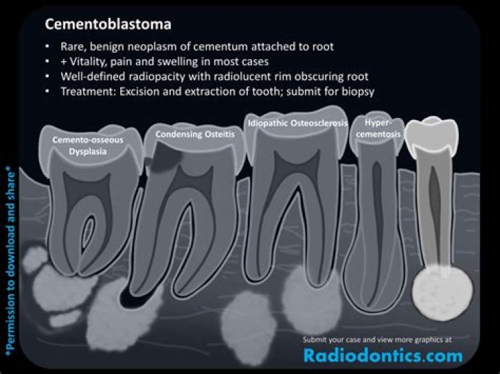 What to do with cementoma?