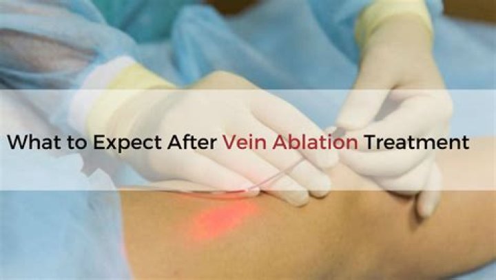 What to expect after ablation?