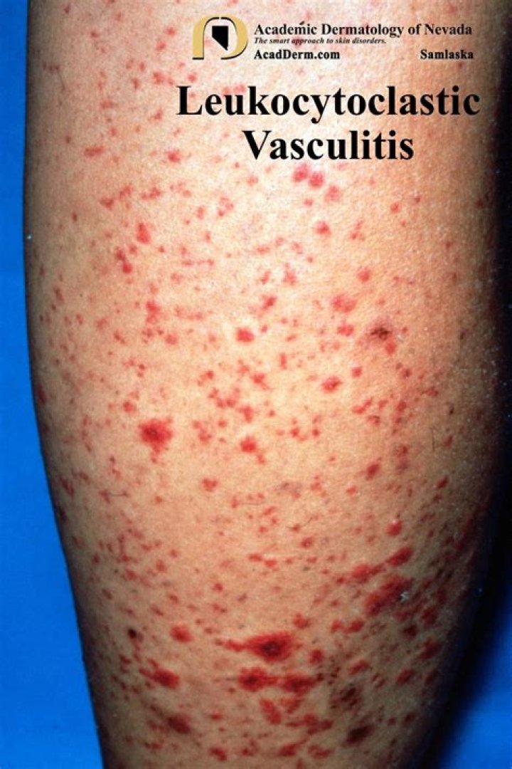 What vasculitis is leukocytoclastic?