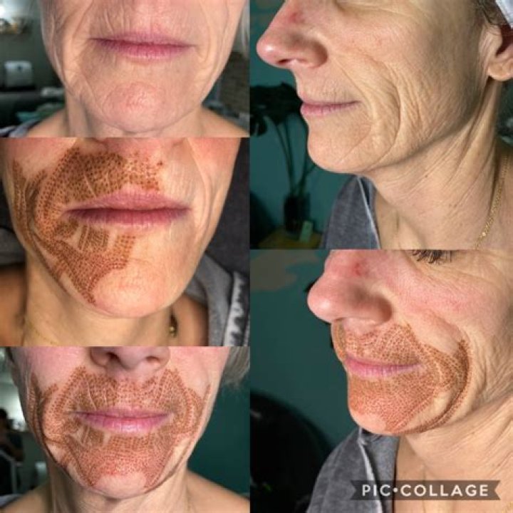 Whats plasma skin tightening?