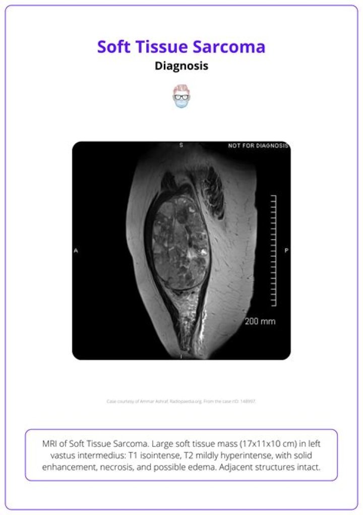 Whats soft tissue sarcoma?
