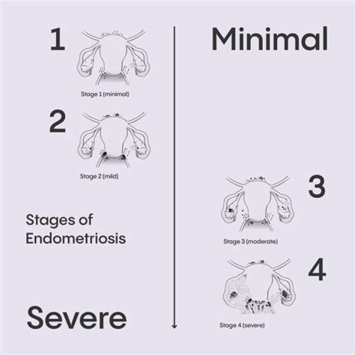 Whats stage 4 endometriosis?