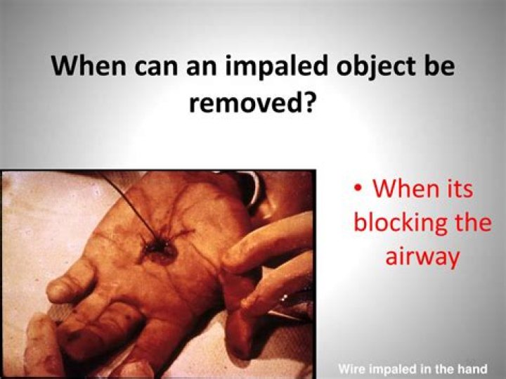 When can an impaled object be removed?