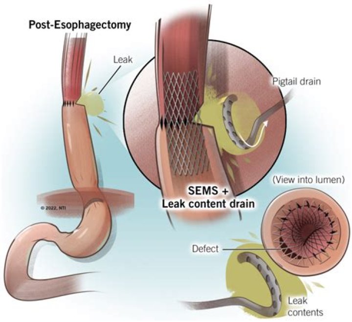 When do anastomotic leaks occur?