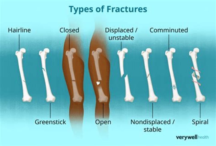 When does a hairline fracture hurt?