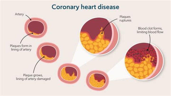 When does coronary thrombosis occur?