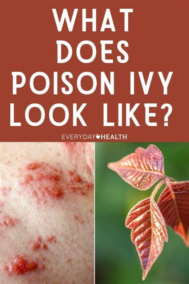 When does poison ivy stop oozing?