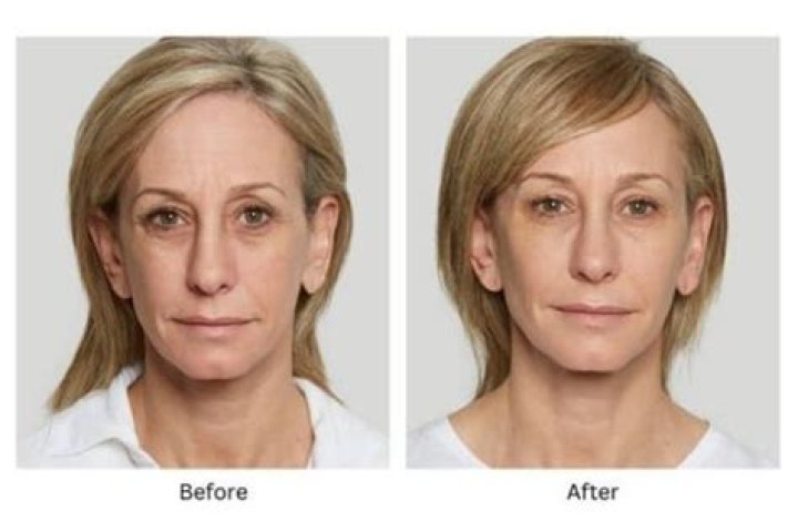 When does sculptra start working?