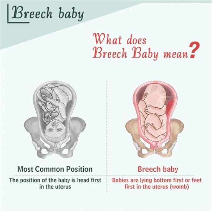 When is external cephalic version done?