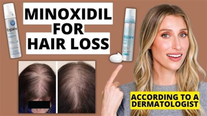 When minoxidil does not work?