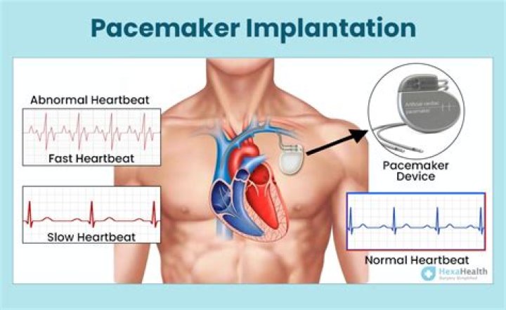 When pacemaker is implanted in heart?