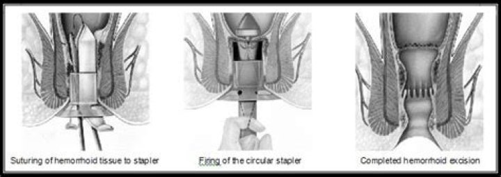 When to do herniotomy?
